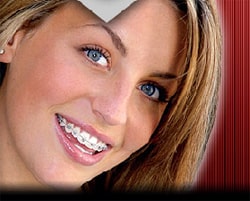 ارتودنسی به روش دیمون